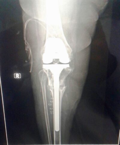 Total Knee Replacement