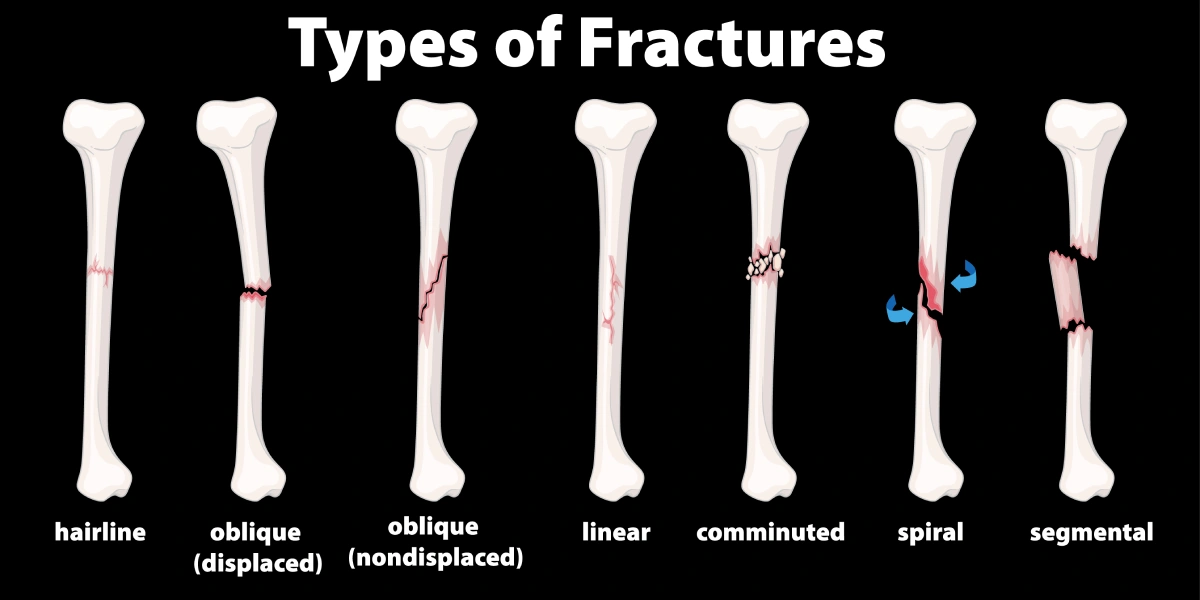 Nonunion Fractures Treatment