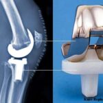 how long do knee implants last