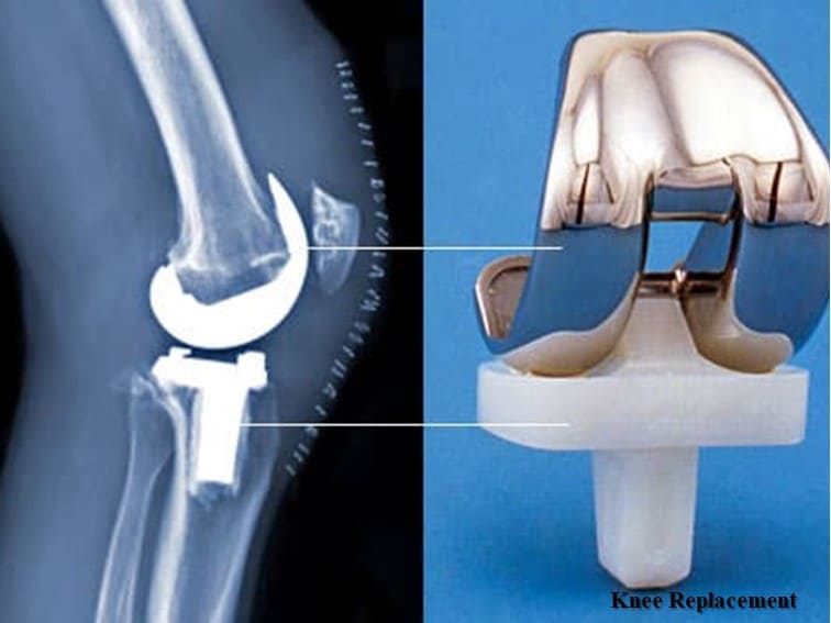 how long do knee implants last