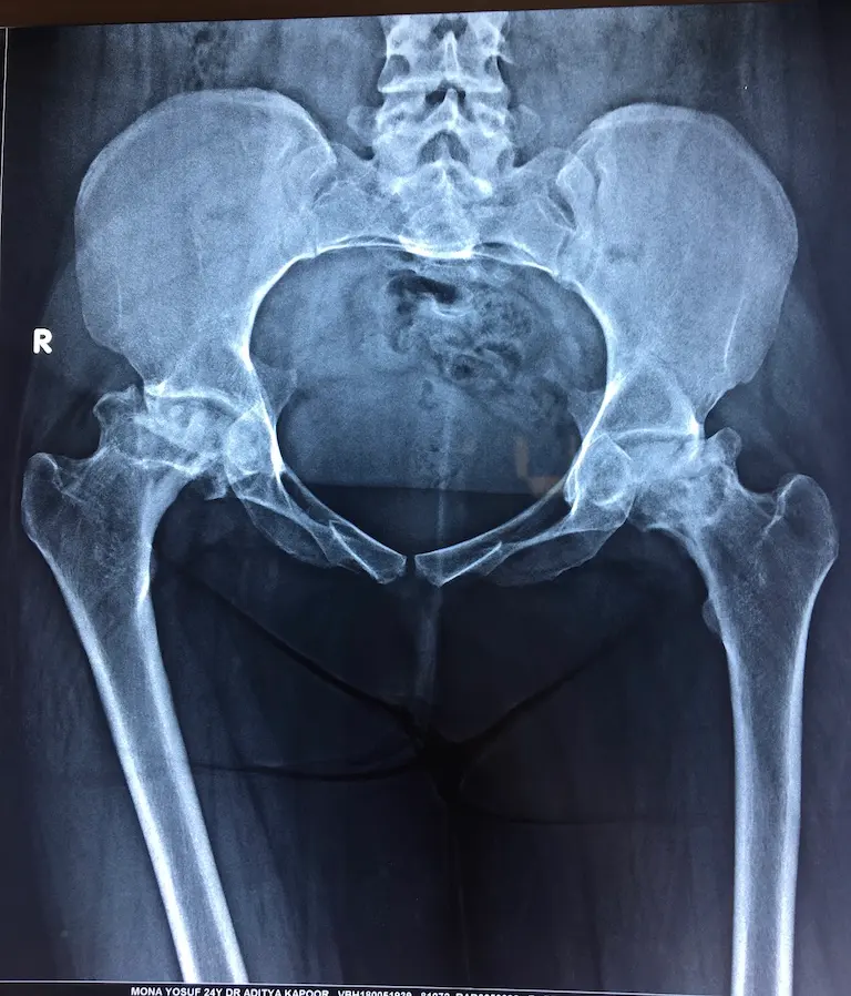 Severe Avascular Necrosis of Both Hips