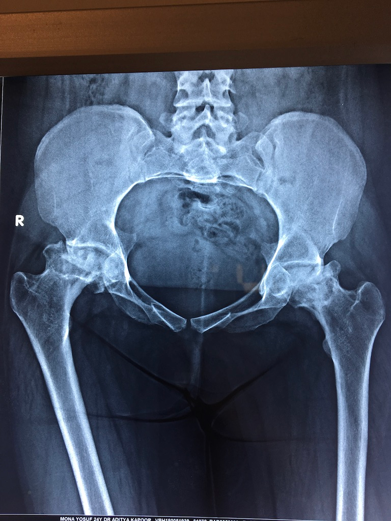 Severe Avascular Necrosis of Both Hips