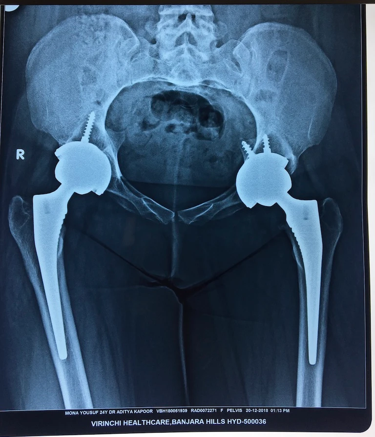 Uncemented Ceramic Bearing Hip Replacements