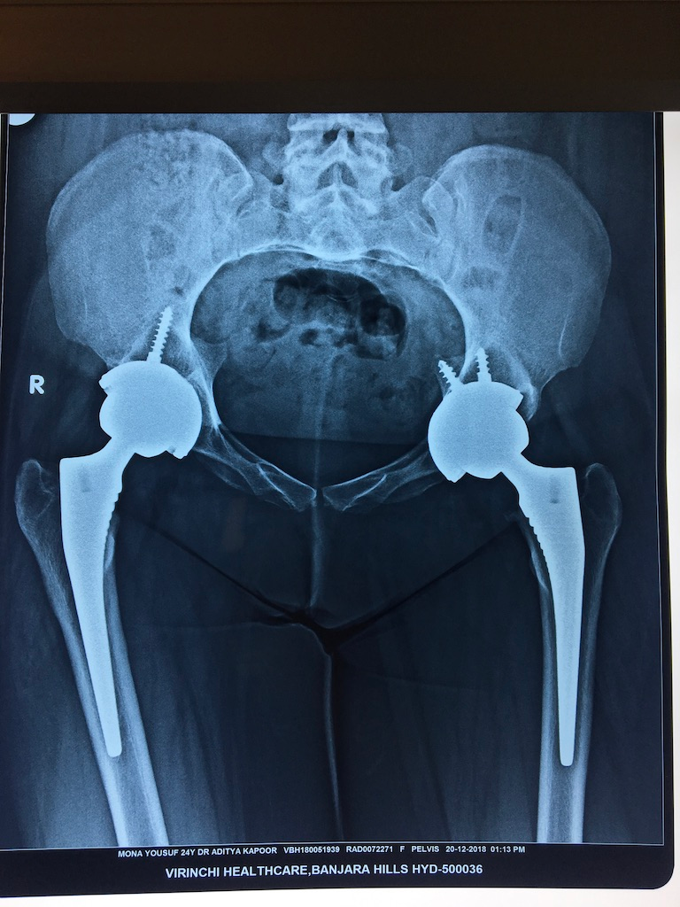 Uncemented Ceramic Bearing Hip Replacements
