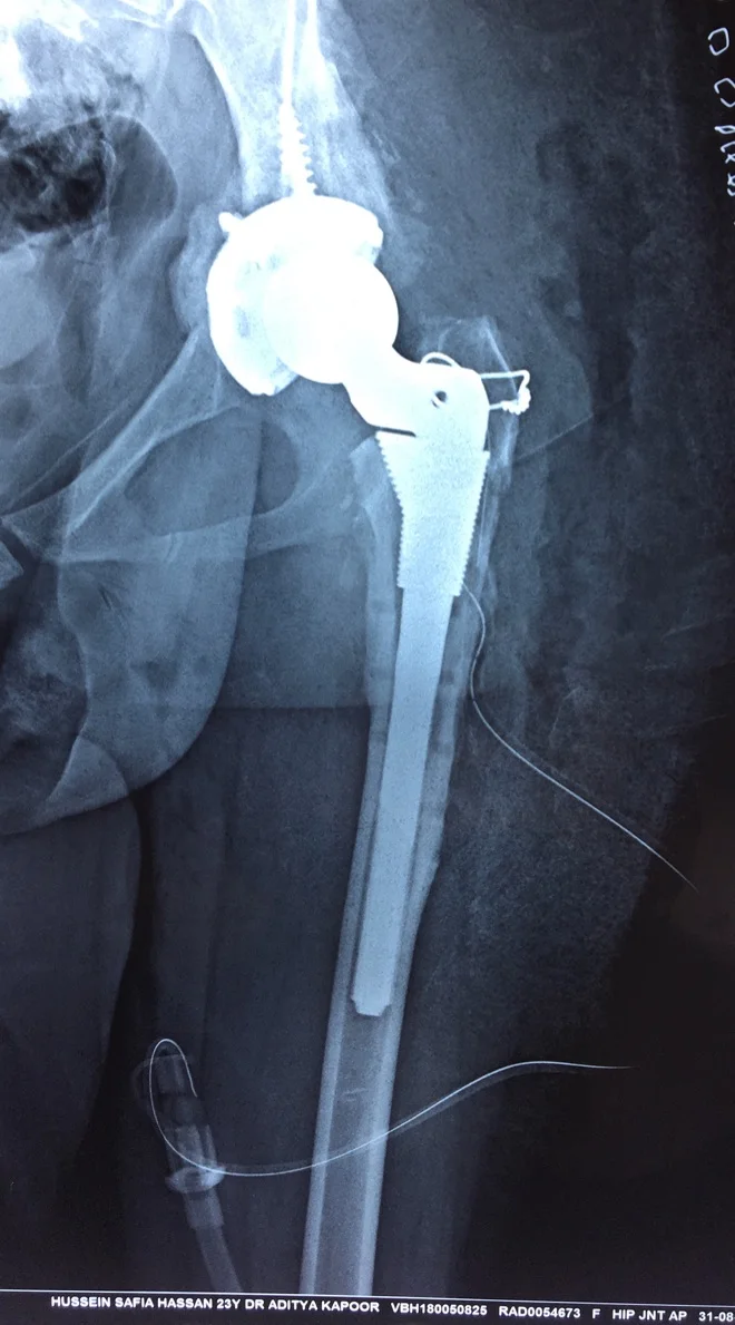 Complex Primary Hip Replacement in Previous Failed Fusion