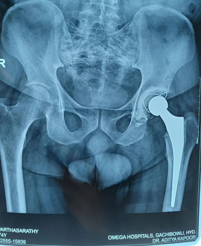 Cemented Total Hip Replacement