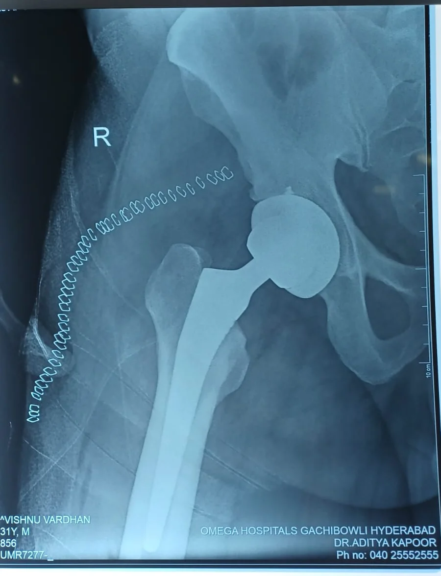 Ceramic Bearing Uncemented Total Hip Replacement