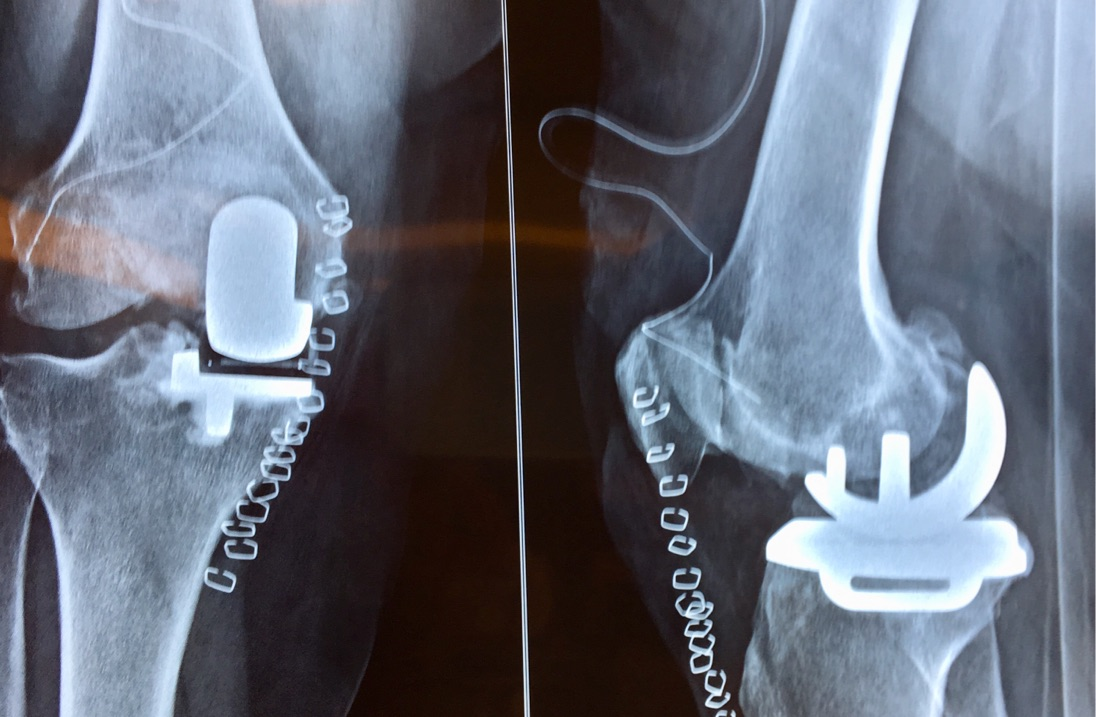 Post-operative X-ray - Partial Knee Replacement