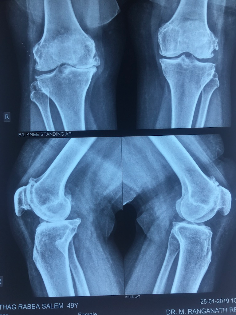 Pre-operative X-ray - Partial Knee Replacement