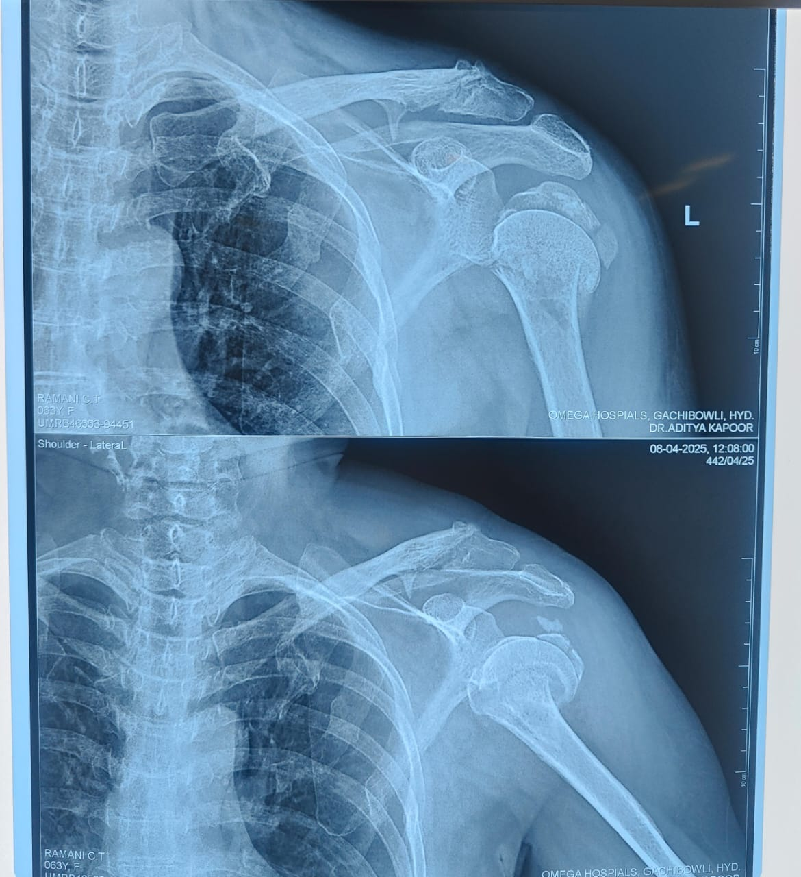Reverse Shoulder Replacement