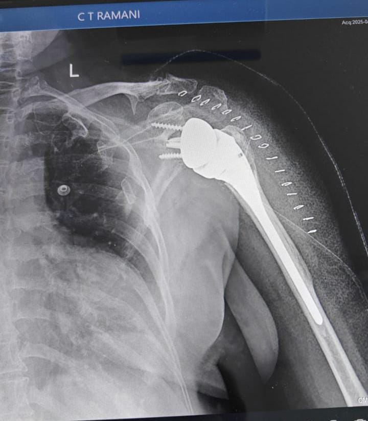Reverse Shoulder Replacement Procedure