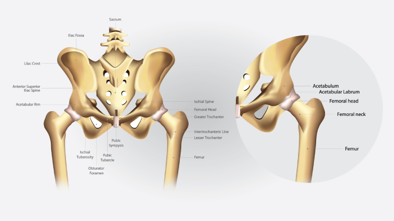 Revision Hip Replacement