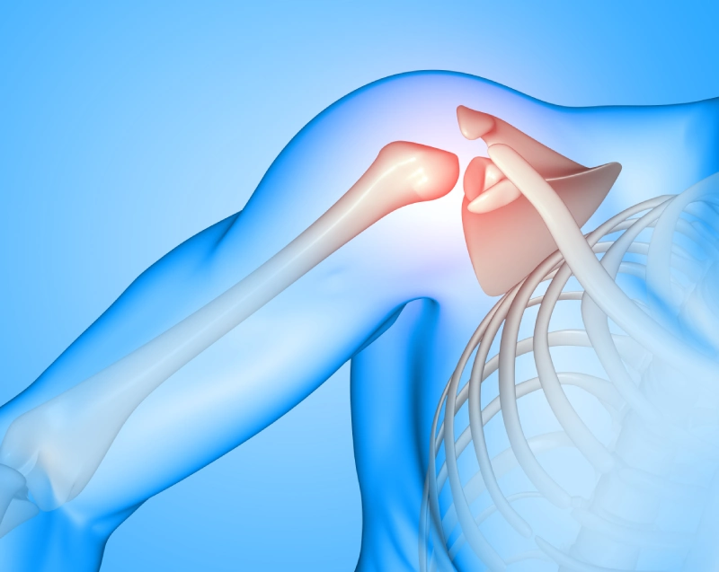 Shoulder Hemiarthroplasty