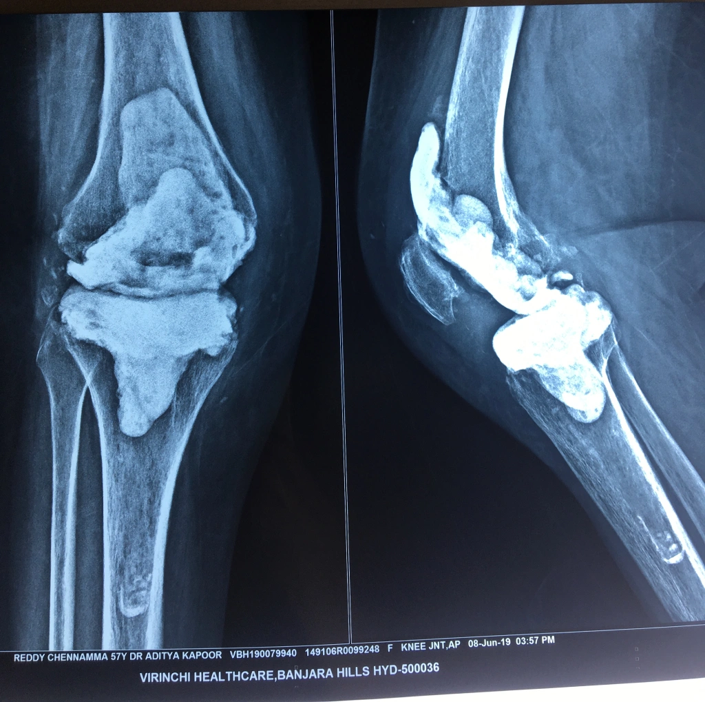Revision Knee Replacement X-ray