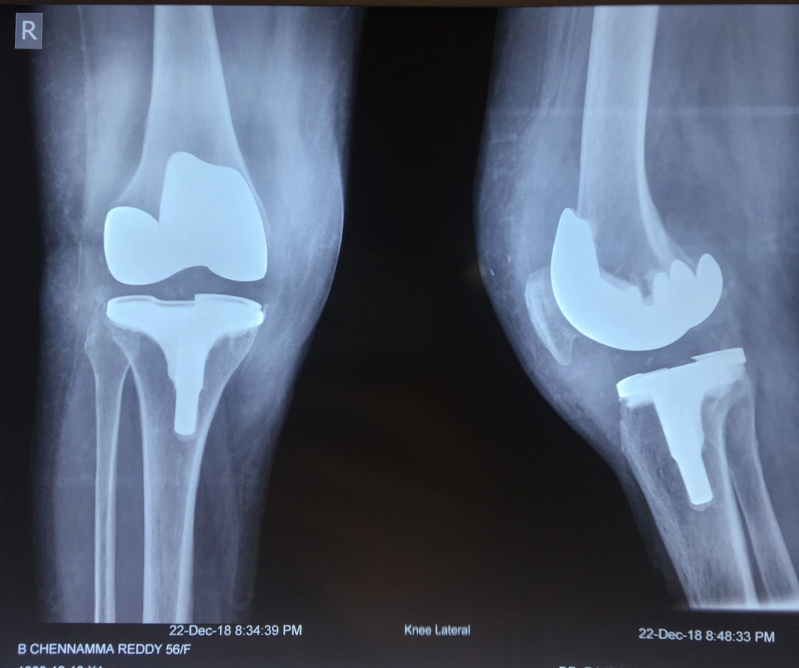 Revision knee replacement